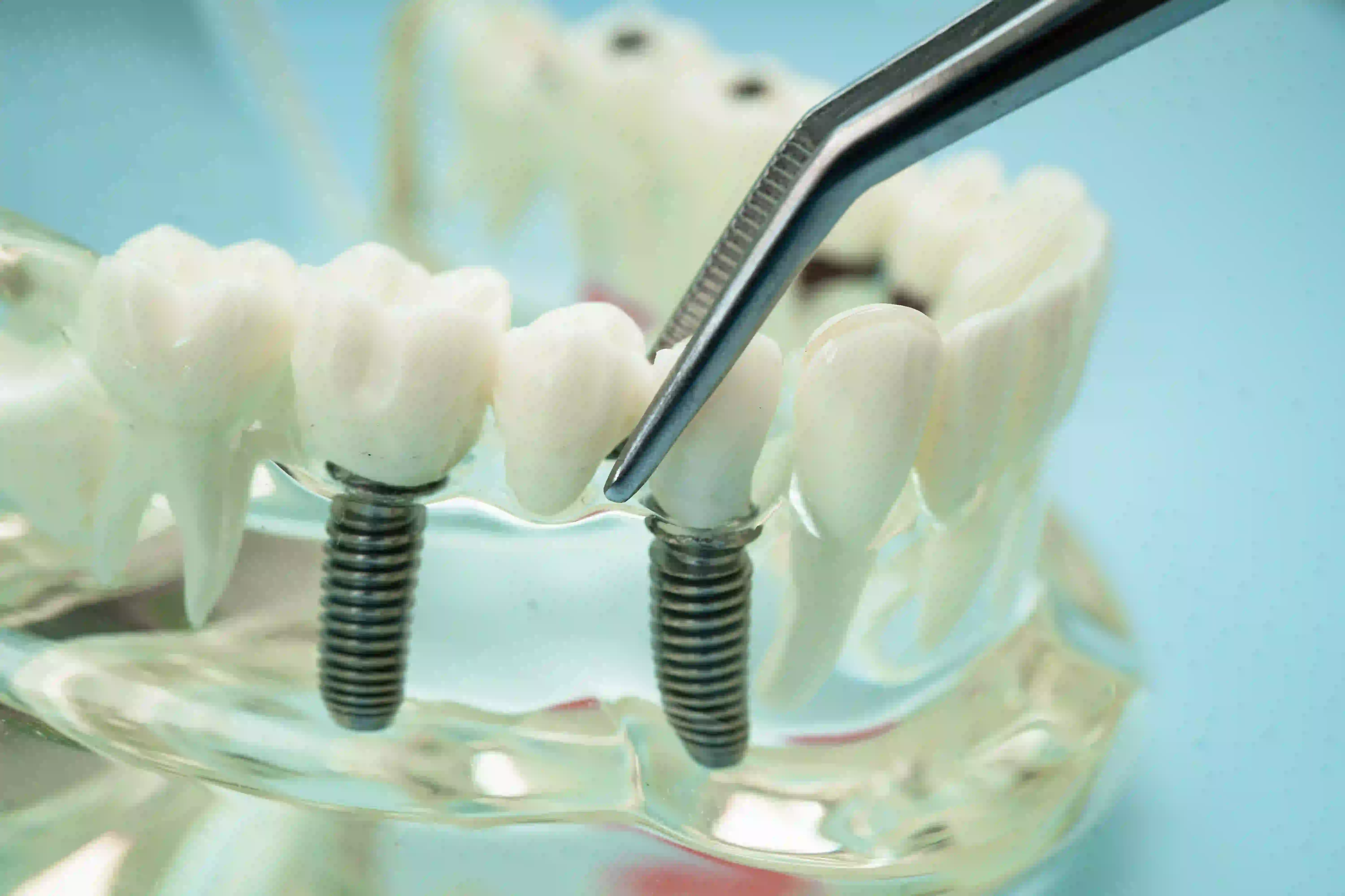 Modelo dental utilizado para explicar tratamientos periodontales